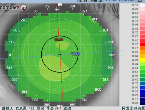 角膜地形图的解读
