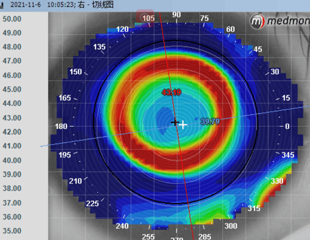角膜地形图的解读