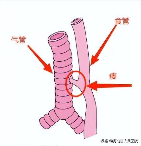 气管食管旁沟图片