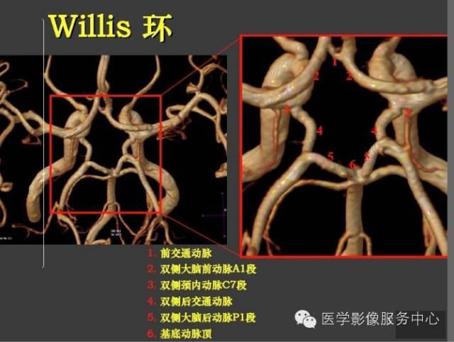 大脑动脉环影像图图片