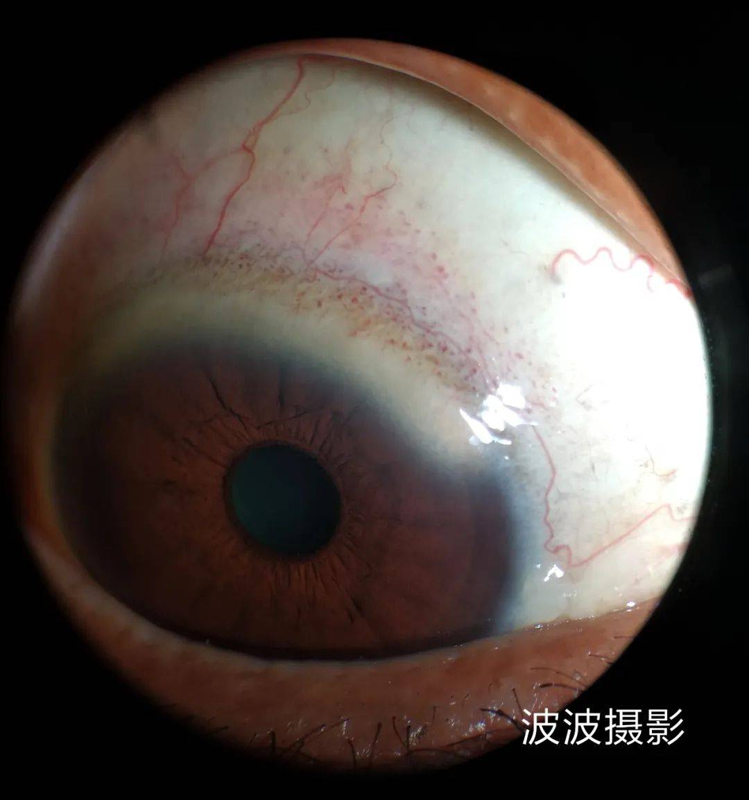 眼科图谱100张 | 裂隙灯下眼科图片分享_角膜_秘籍_医生