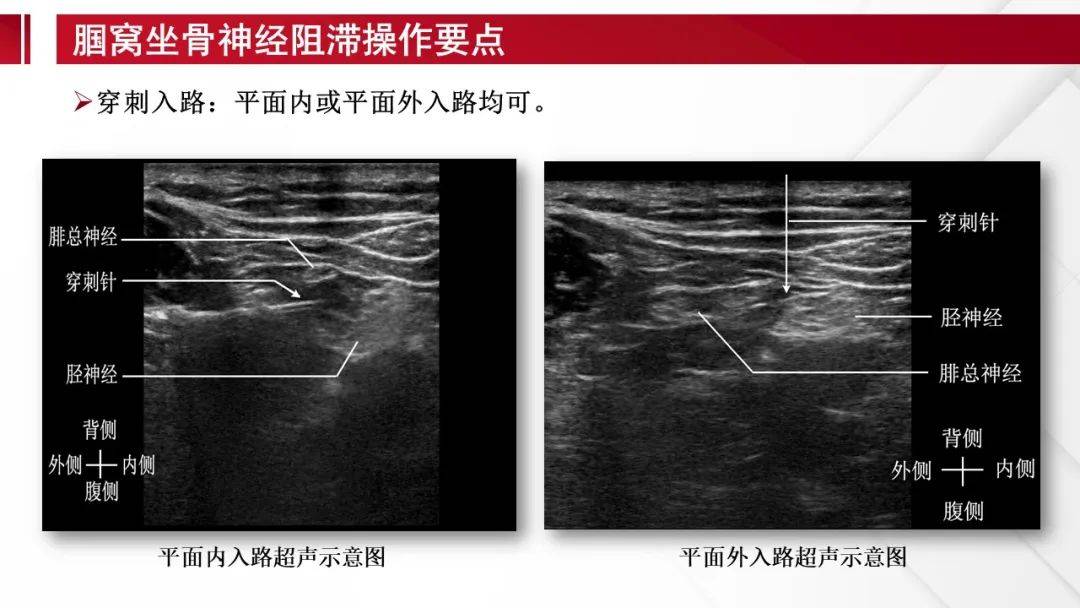 腓总神经超声图图片