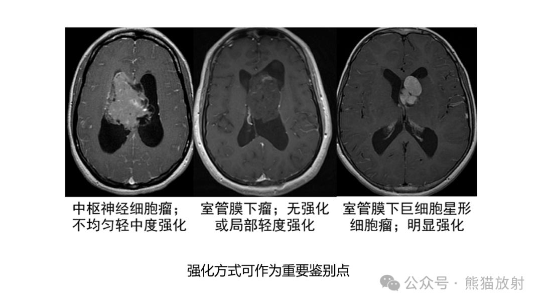 侧脑室肿瘤图片