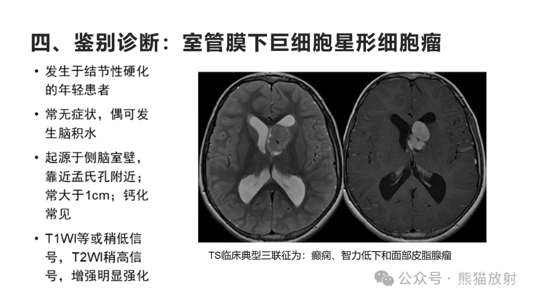 侧脑室肿瘤图片