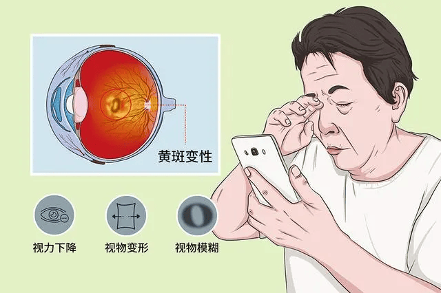 【健康科普】全国爱眼日，我们一起来聊聊黄斑变性那些事儿_病变_检查_生活