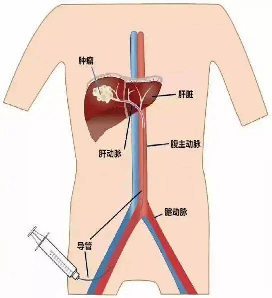 肝癌介入栓塞图片图片