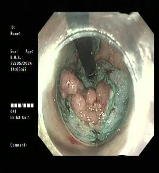【新闻快递】浙新医师联手在内镜粘膜下剥离术成功切除直肠巨大肿物
