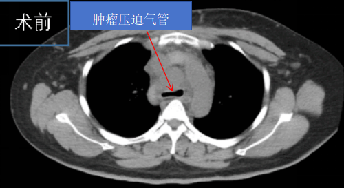 成功运用ct引导下右肺及纵隔肿瘤碘