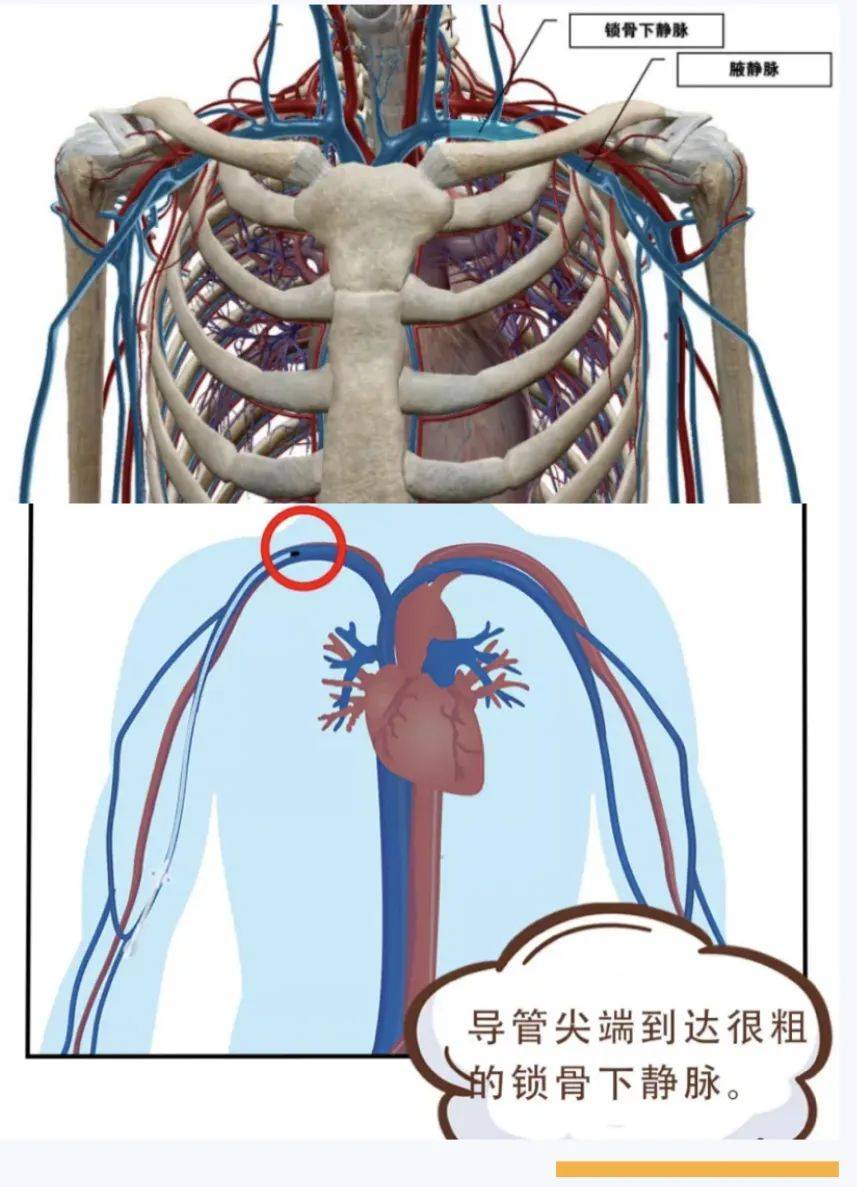 头静脉或肱静脉内,导管尖端位置放在腋静脉胸段甚至达到锁骨下静脉,是