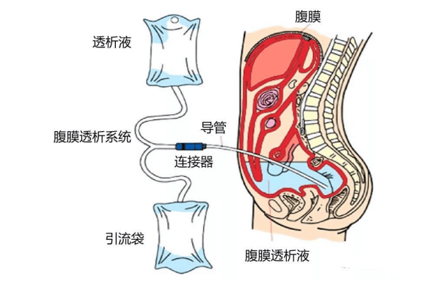 不影响日常生活;同时降低腹腔压力也是自动化腹膜透析的一个关键亮点