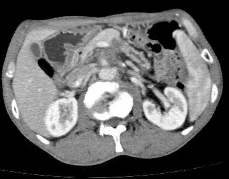 长治医学院附属和济医院成功引进肿瘤消融新技术纳米刀