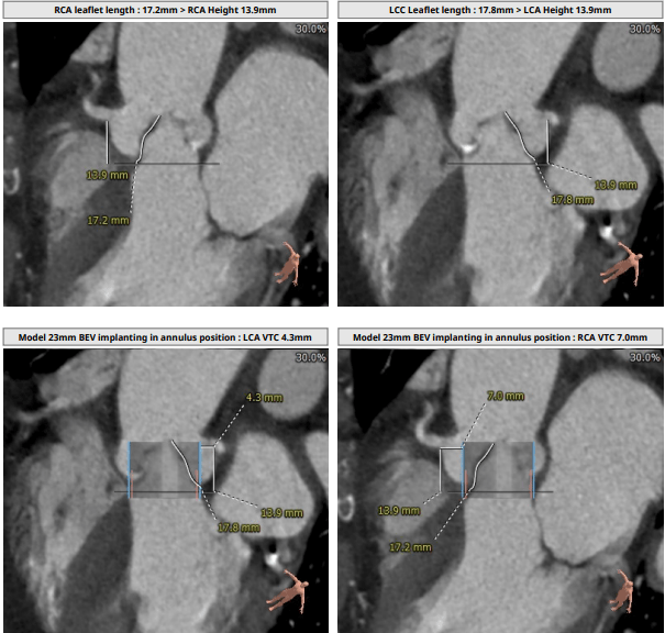 8mm ;rca 高度13.9mm,瓣叶长度17.2mm.考虑冠脉阻塞风险较高.