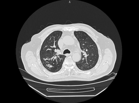 肺结核ct图片图解图片