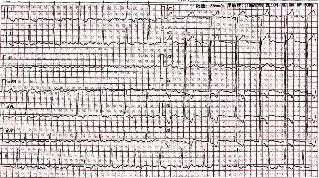 心电图「万能」读图 5 步法!