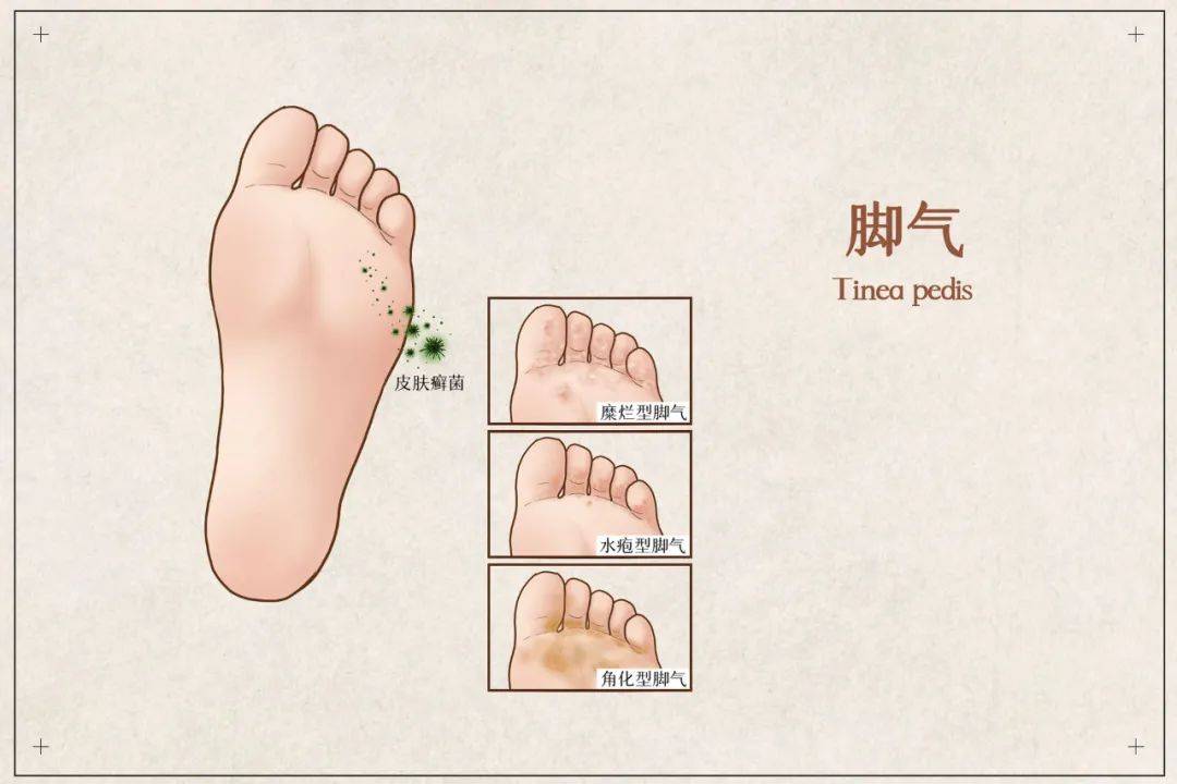 痒痒痒!一到夏季脚气就瘙痒难忍,还反复发作?皮肤科医生教你这样对付_真菌_袜子_治疗