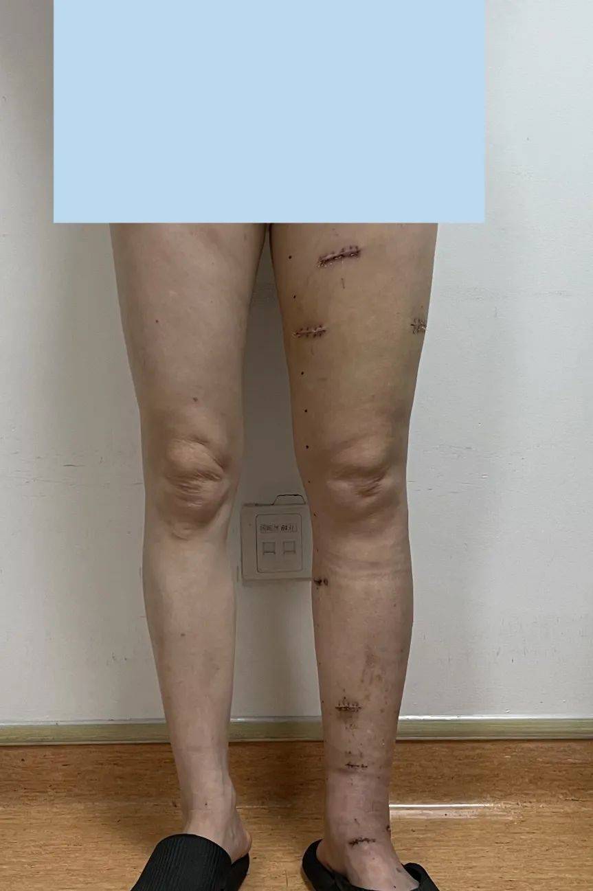 肿瘤术后8年下肢肿成大象腿医生将淋巴管与静脉吻合后成功瘦腿