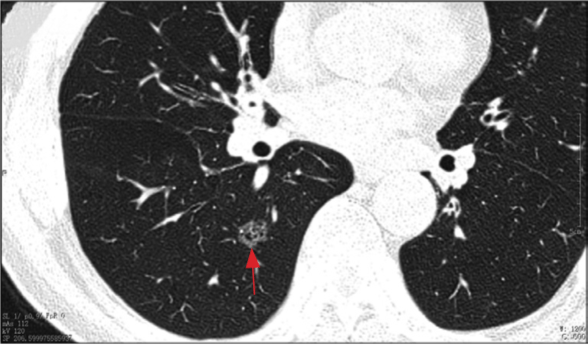 经肋间单孔胸腔镜右下肺背段切除术|《胸外科单孔腔镜