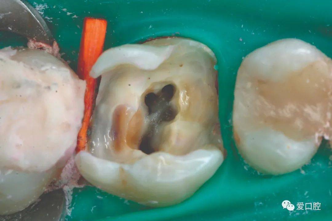 单根管牙的髓室和根管为连续的管状,很难从形态上辨认根管口;多根牙则