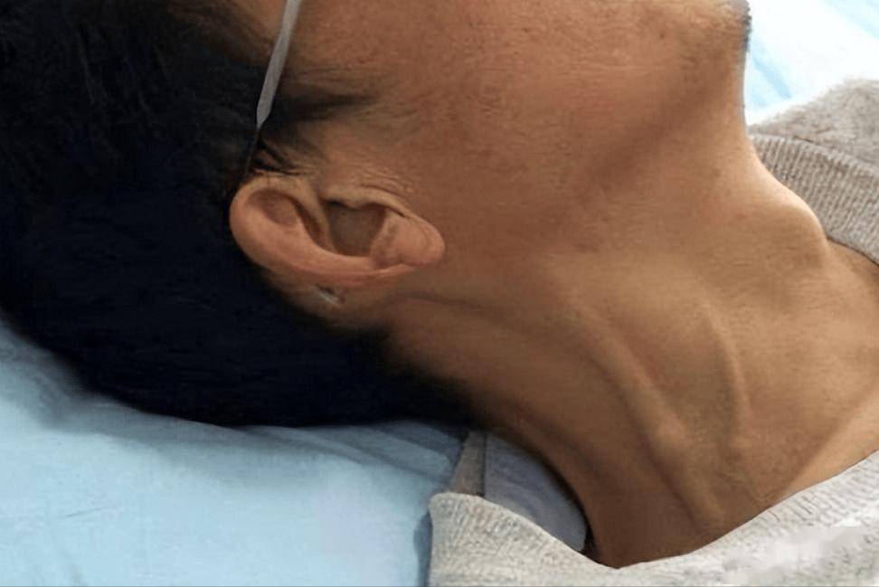 颈静脉怒张是一种可见于心脏衰竭患者的现象,当心脏的泵血功能不足以