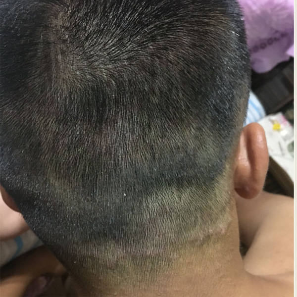 夏天起头皮屑用什么洗发水?控油去屑洗发水排行榜10强