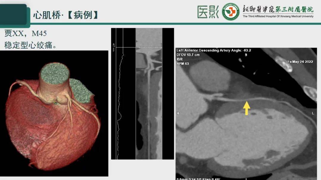 冠脉cta—心肌桥诊断要点