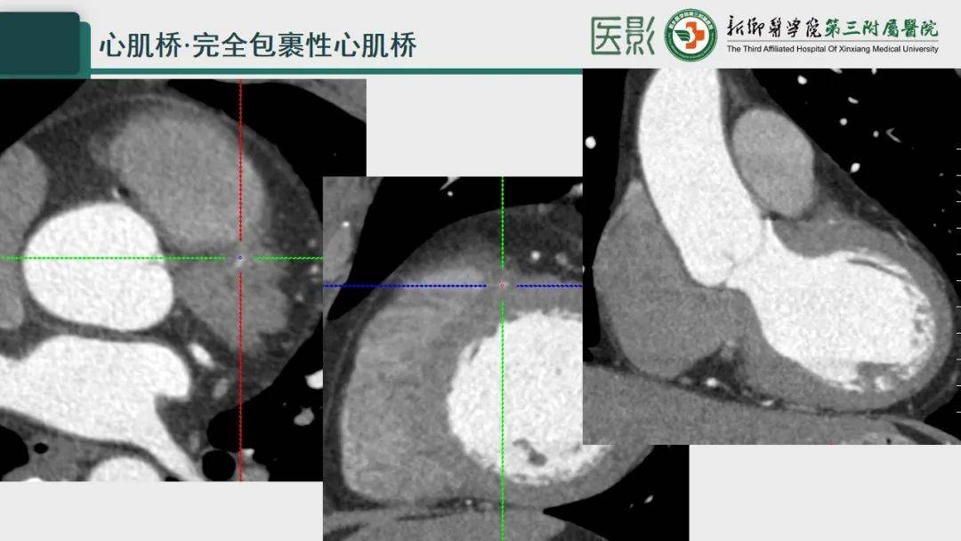 冠脉cta—心肌桥诊断要点