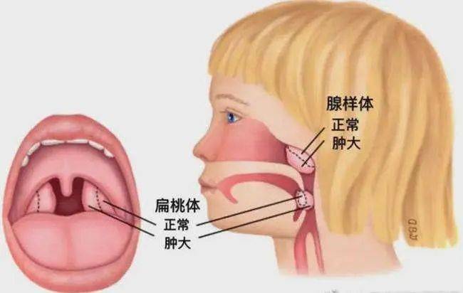 腺样体,也称为咽扁桃体或增殖体,位于鼻咽部