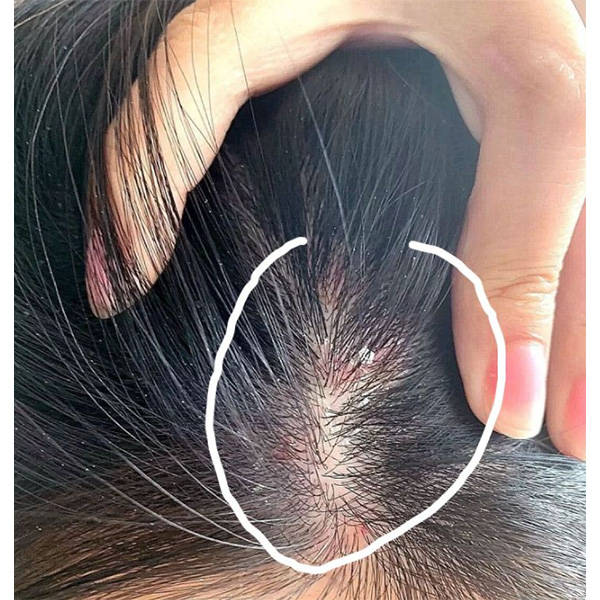 头皮屑多又痒用什么洗发水好?男士去屑洗发水排行榜前十名