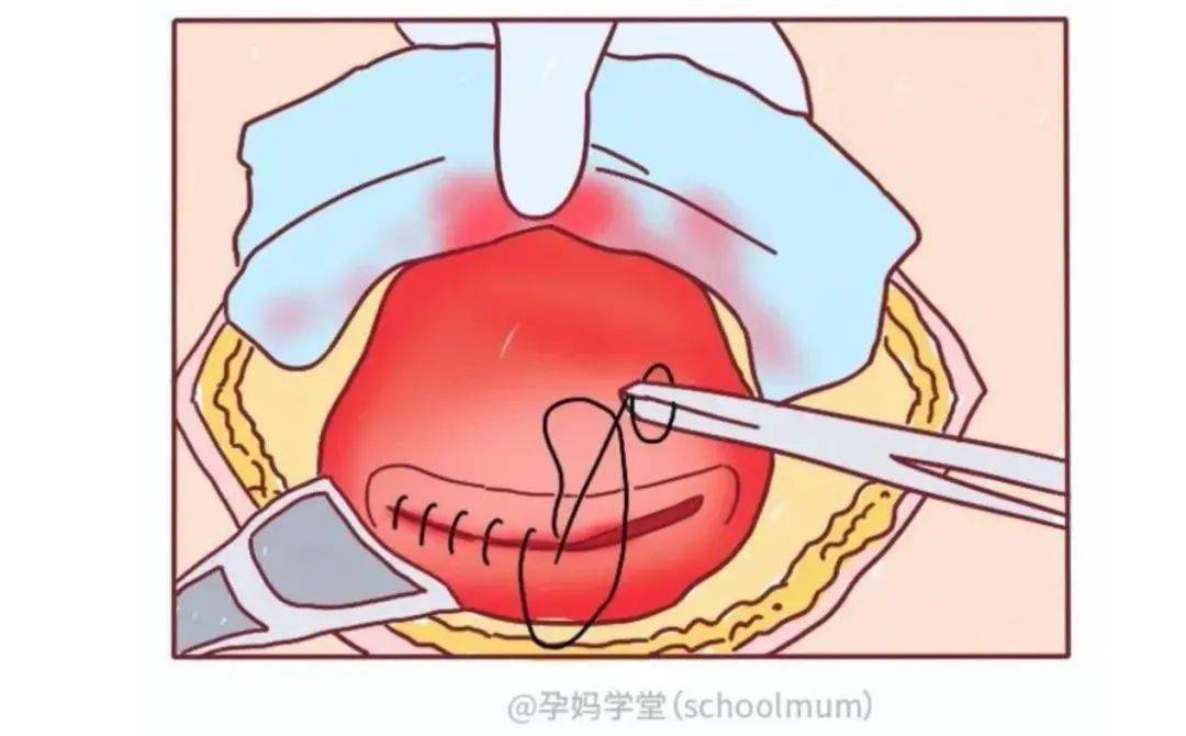 产后宫腔分离图片