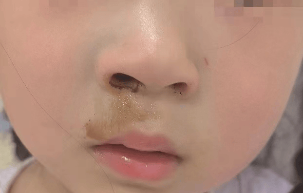 家长发现小美的右侧鼻子肿胀,而且鼻腔内时不时有黄褐色分泌物流出