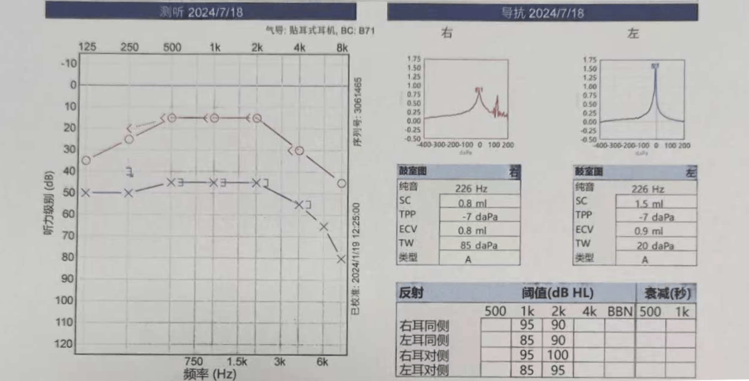 耳朵响,眩晕,当心听神经瘤!