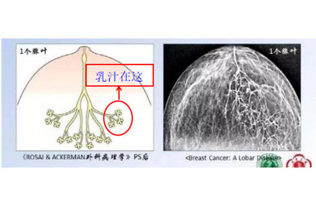 我的“副乳”怎么长到腋下了？(图1)