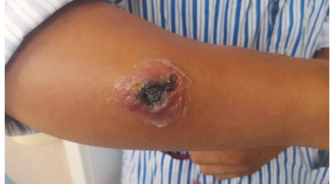 发现炭疽病例,5人隔离治疗!炭疽是什么?如何预防?