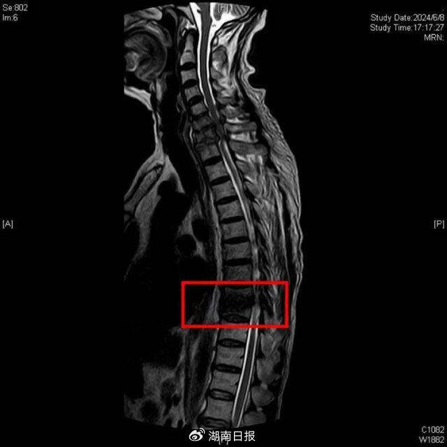 脊柱裂核磁图片