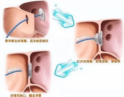 卵圆孔未闭封堵器图片图片