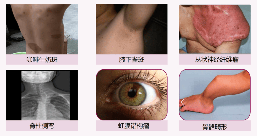 关注罕见病——浙江省中医院儿童神经纤维瘤病中西医mdt门诊启动