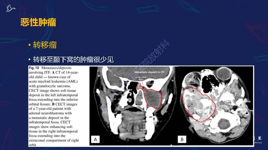 颞下窝肿瘤图片