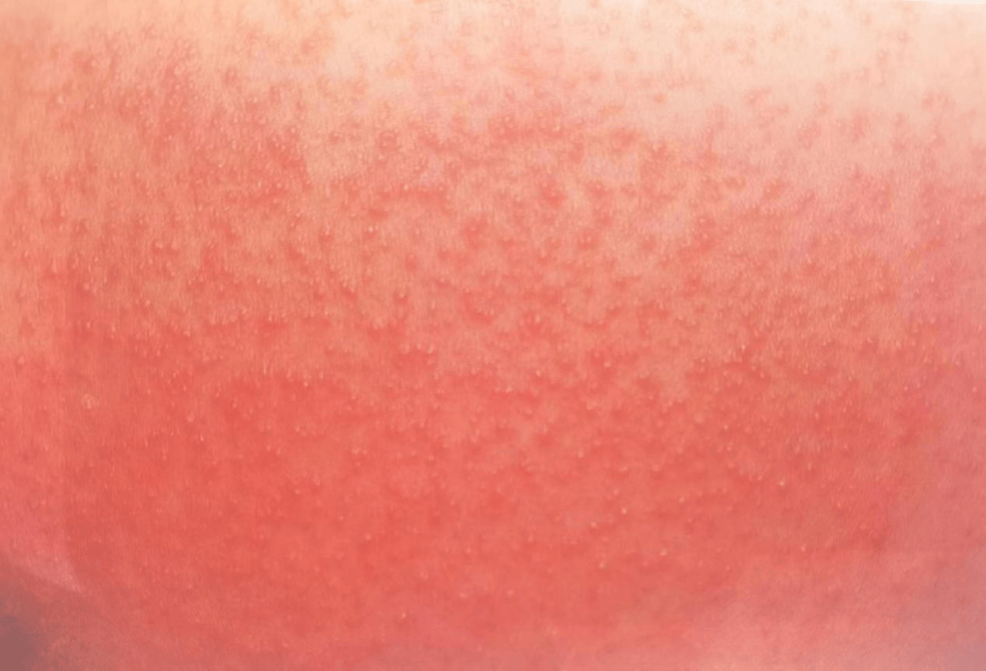 医生:别把这病当痱子治_皮肤_皮炎_过敏原