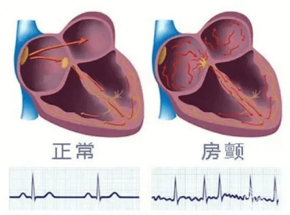 房颤心电图特点图片