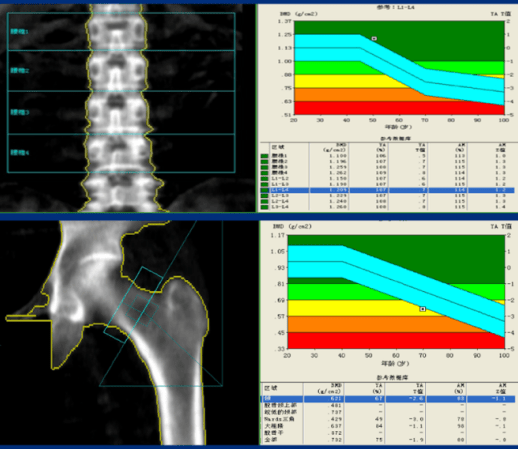 骨密度曲线图图片图片