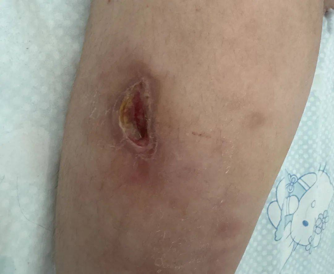 伤口_可可_孩子