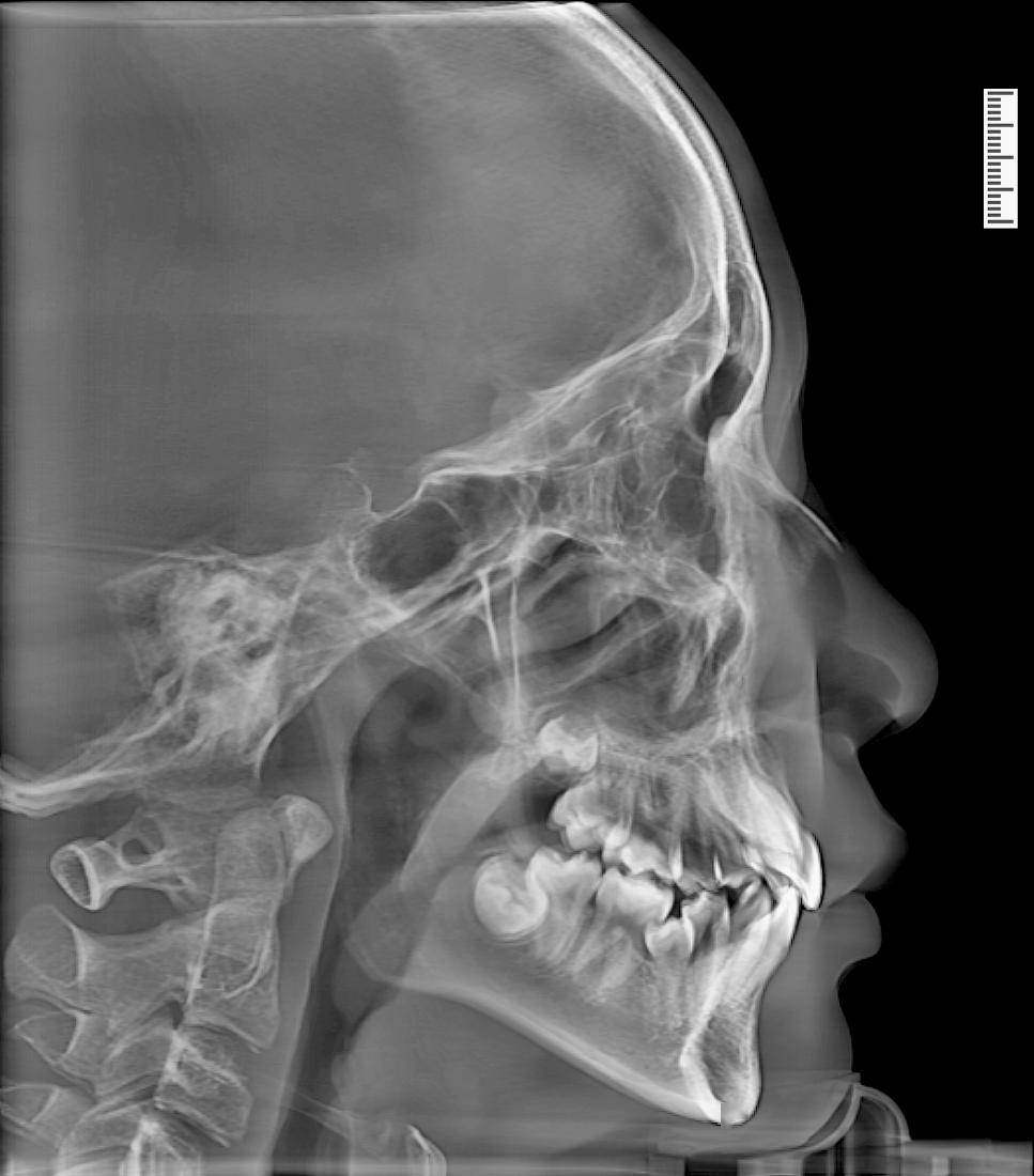 影像鉴赏3d正侧位单次大视野ct拍摄可同时获取ct,3d全景,3d正侧位