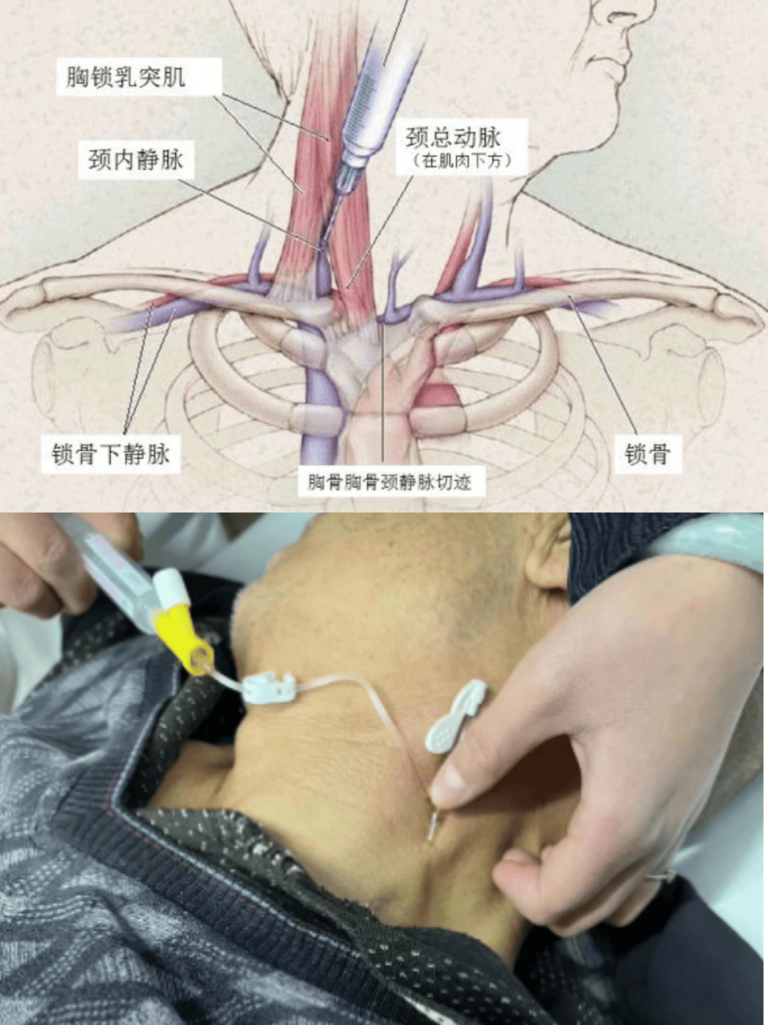 颈内静脉穿刺定位图片