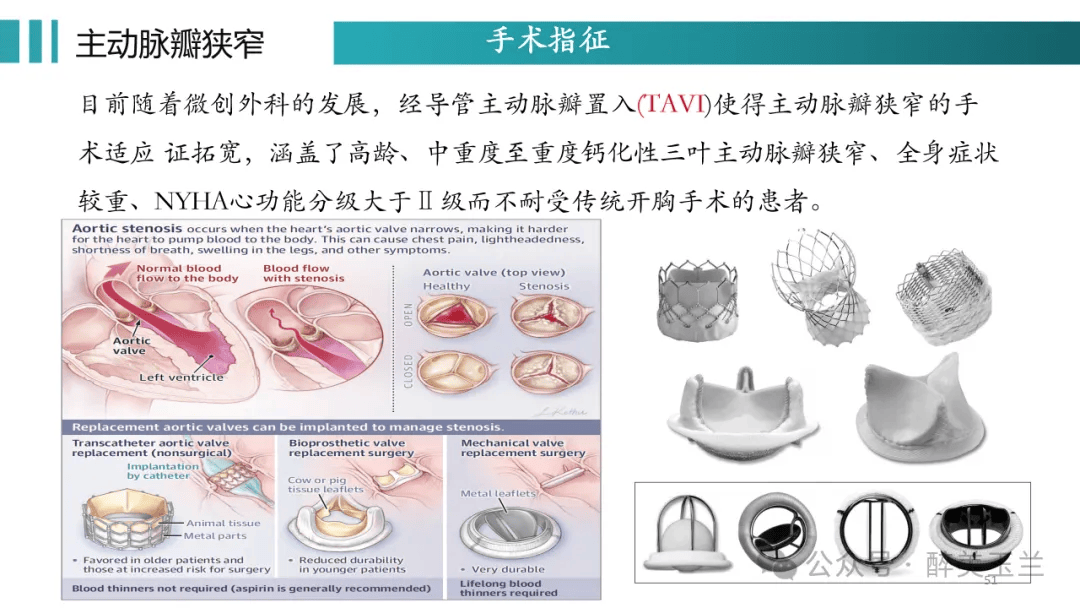 主动脉瓣上缩窄图片