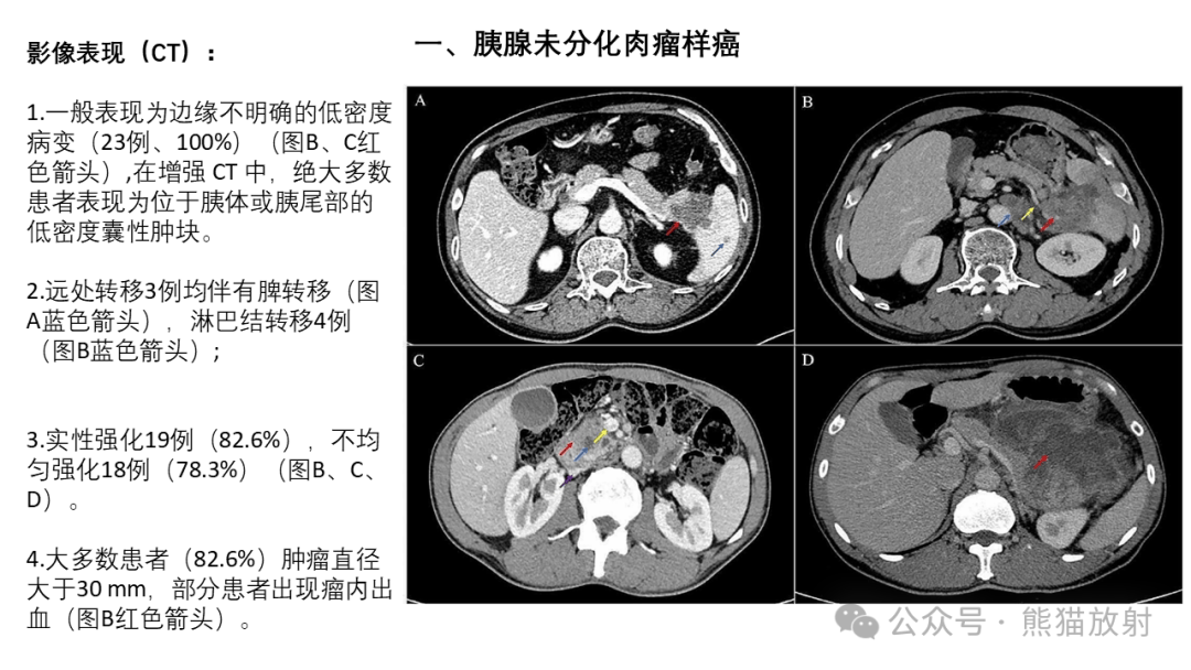 胰腺结节图片