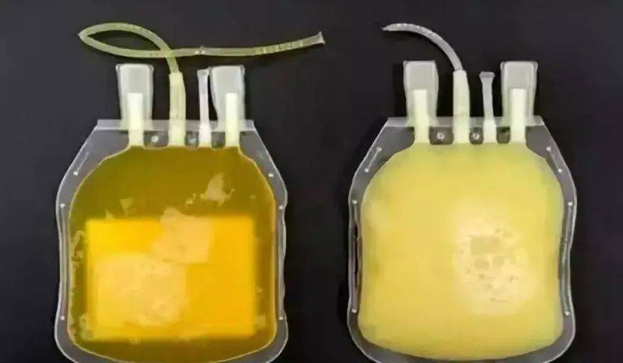 该如何治疗?_血浆_置换_技术