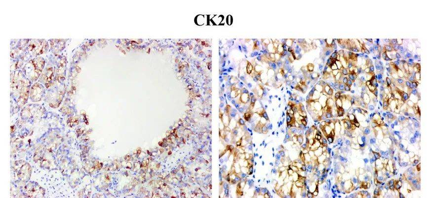 病例精讲 | 嗜酸性实性囊性肾细胞癌（ESC RCC）一例(图7)