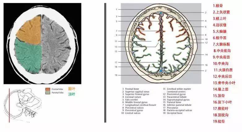 颞叶钩回疝ct解剖图片