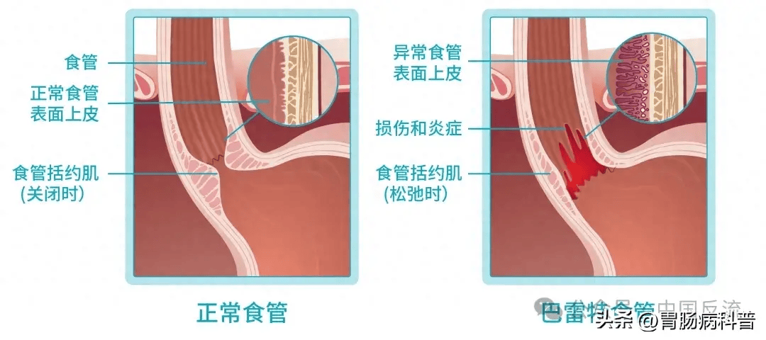 癌前病变——巴雷特食管,到底长啥样?该怎么治?