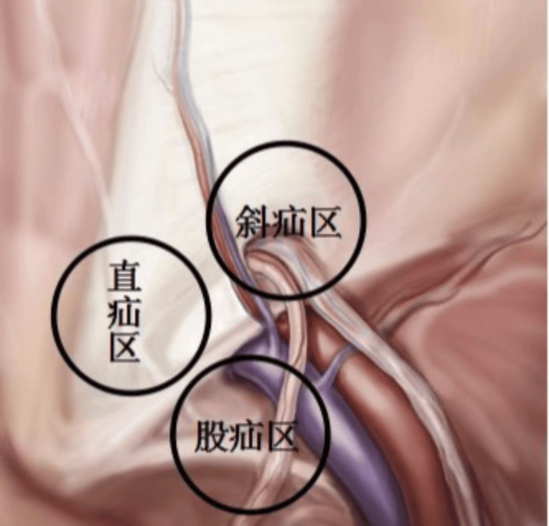 腹壁间层疝图片